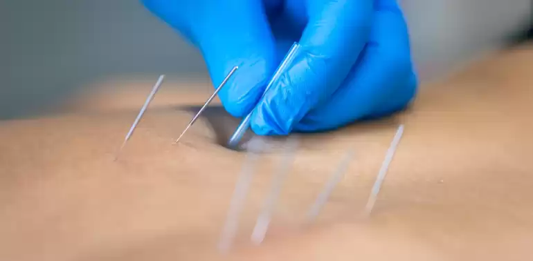 Dry-Needling